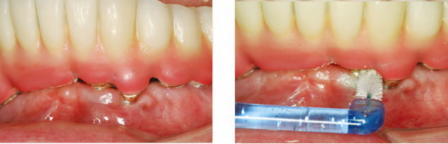 インプラントデンチャーでの使用例